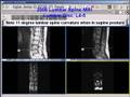 2008 Lumbar Spine:  Tear in Annulus and Lumbar Spine Curvature