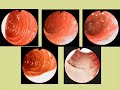 ENFERMEDAD CELIACA ENDOSCOPIA 1