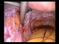 Laparoscopic Excision of Endometriosis over Ureter
