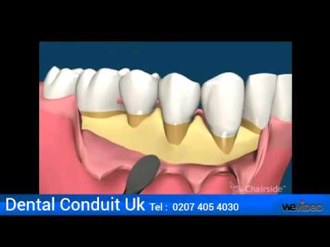 how to cure bleeding gums