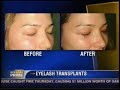 CNN Headline News - Eyelash Transplant CNN Headline News - Eyelash Transplant