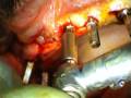 Implantologia dentale a carico immediato Implantologia dentale a carico immediato