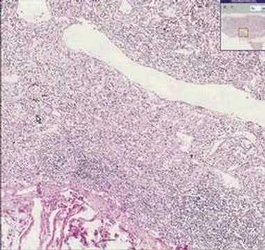 Histopathology Lymph node ...
