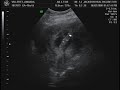 Villeret Baby Boy 3