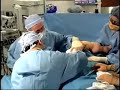 Iowa City Plastic Surgery Live: Arm Lift 2 of 14