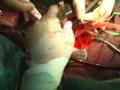 pediatric heart transplant