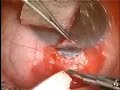 Trabeculectomy Mitomycin C Left eye