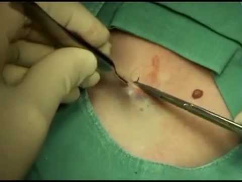 how to perform lymph node biopsy