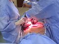 Awesome c-section. Miracle baby!
