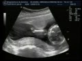 Davi 18 semanas