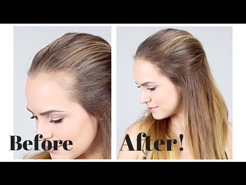 how to fix your hairline