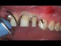 Minimal Prep Veneers with Implant Restoration Minimal Prep Veneers with Implant Restoration
