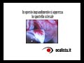 Trabeculectomia - terapia chirurgica del glaucoma