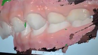 Pistas Diretas - Distoclusão