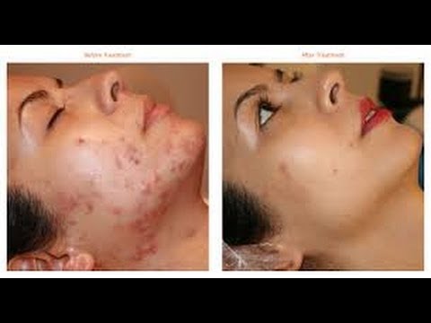 how to get rid pus filled bumps
