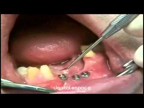 gencive - 