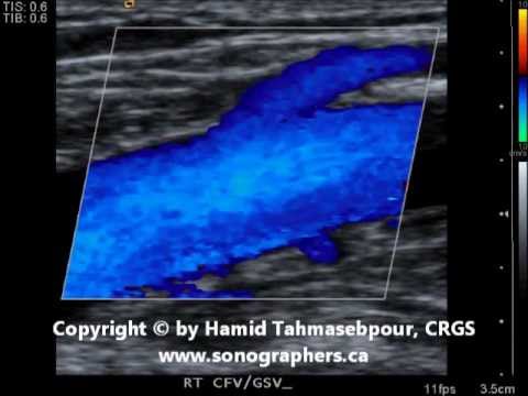 how to test for venous leak