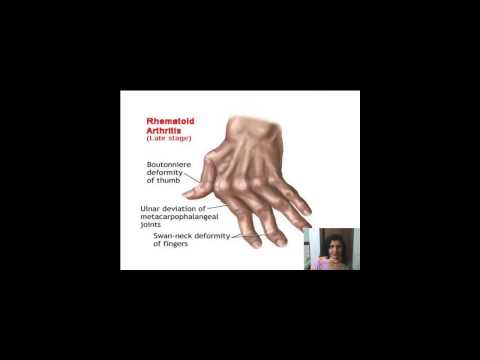 how to relieve ra pain