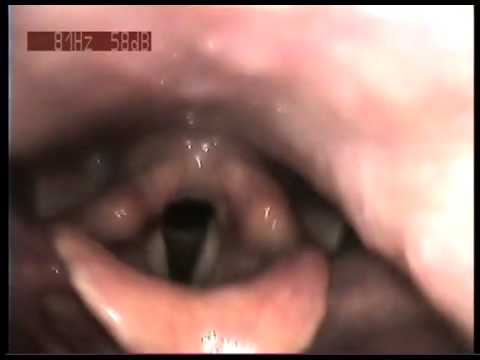 how to cure epiglottitis