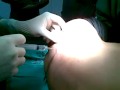 Aspirado de medula osea en niño con leucemia