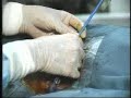 Hemo Cath Long Term