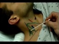 Cadaver Surface and Ultrasound Guided Anatomy of Nerve Blocks in Anesthesia Program