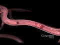 MERCI clot retreival catheter for ischemic stroke MERCI clot retreival catheter for ischemic stroke