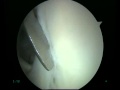 Arthroscopic Nondislocated Bankart Deficiency (Perthes Lesion) Arthroscopic Nondislocated Bankart Deficiency (Perthes Lesion)
