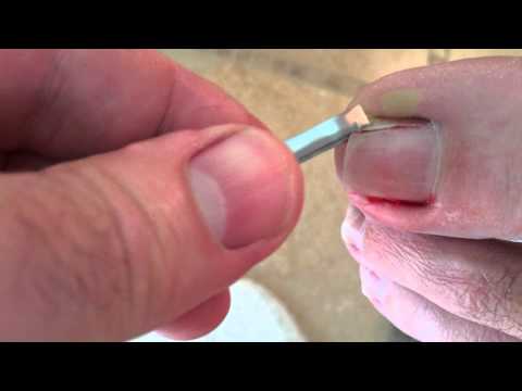 how to get rid of an ingrown toenail
