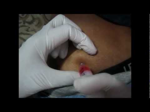 IM Injections
