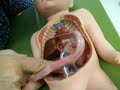 Fetus