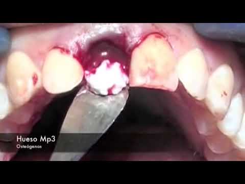 cirugía dental - Los esperamos en www.canalcirugiabucal.com.