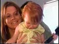 Hemangioma Forehead/TLC/Part 4