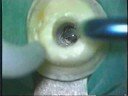 endo(instrument removal) endo(instrument removal)