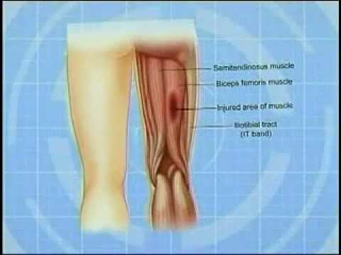 how to treat a hamstring injury quickly