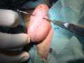 Scarless otoplasty auriculoplasty in prominent ears using Serdev suture technique, serdev@gmail.com