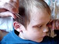 How to Remove Stitches How to Remove Stitches
