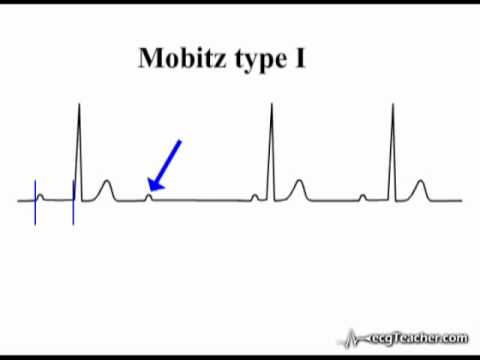 how to treat 3rd degree heart block