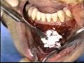 Chin Block Graft Harvesting