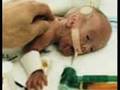 Cerebral Palsy
