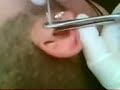 My Tragus