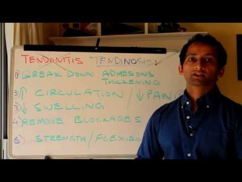 how to treat tendonitis