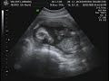 Villeret Baby Boy 2