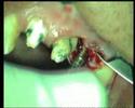 implantes dentales con laser