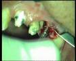 implantes-dentales-c