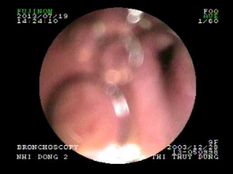 how to treat epiglottis
