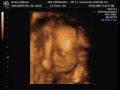 3D Ultrasound 18 wks.