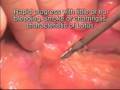 videos de Open Pancreatic By-pass