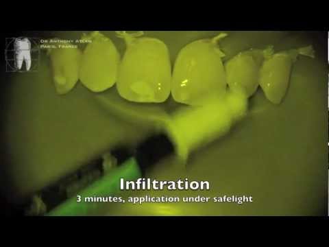 how to treat iv infiltration sites