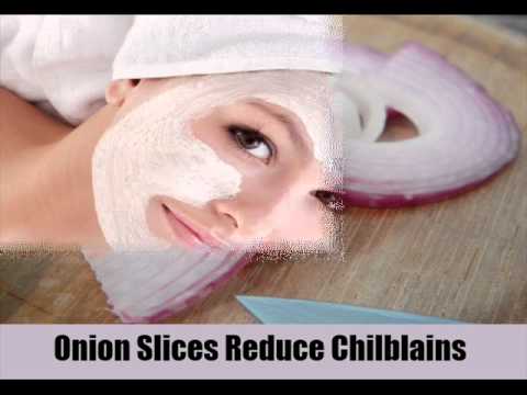 how to cure chilblains